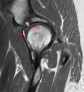 Sagittal proton density-weighted image of hip