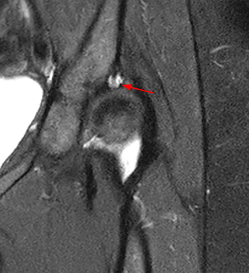 Contiguous coronal fat-suppressed proton density-weighted image of hip