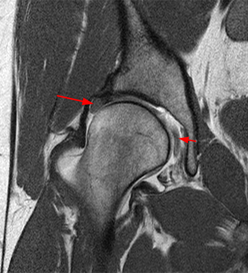 Sequential coronal T1-weighted image from an MR arthrogram of hip