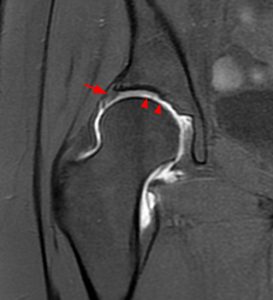 Coronal fat-suppressed T1-weighted medical image of hip