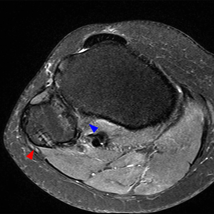 Medical image 11B: Axial fat-suppressed proton density-weighted image