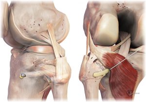 Medical illustration 12A: 3D renders demonstrate posterior proximal tibiofibular reconstruction using LaPrade’s technique