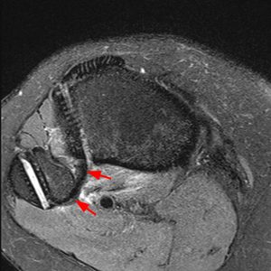 Medical image 12B: A fat-suppressed proton density-weighted axial image demonstrates post-surgical appearance after open PTFJ ligament reconstruction