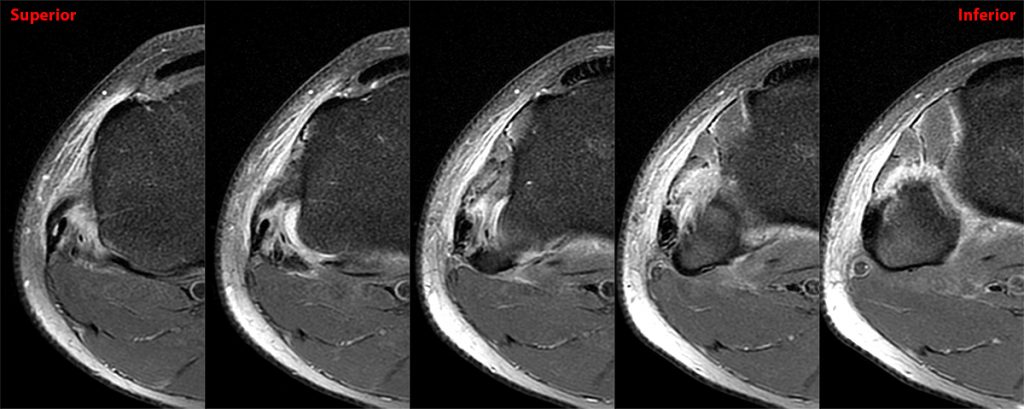 Medical image 1A: Sequential axial fat-suppressed proton density-weighted image through the proximal tibiofibular joint.