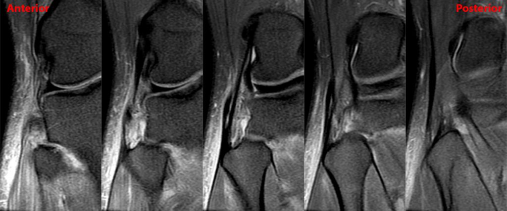 Medical image 1B: Sequential coronal fat-suppressed proton density-weighted image through the proximal tibiofibular joint.