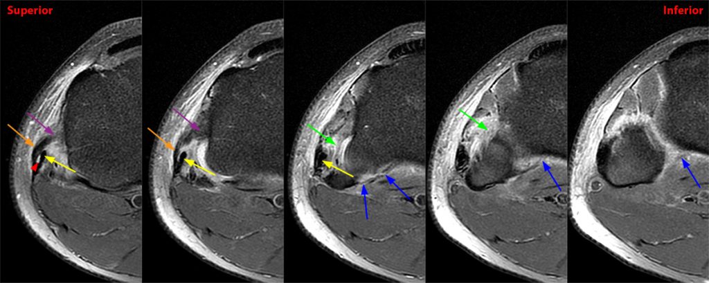 Medical image 2a: Axial images from superior to inferior demonstrate soft tissue edema surrounding the proximal tibiofibular joint.