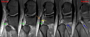 Medical image 2B: Axial images from superior to inferior demonstrate soft tissue edema surrounding the proximal tibiofibular joint.