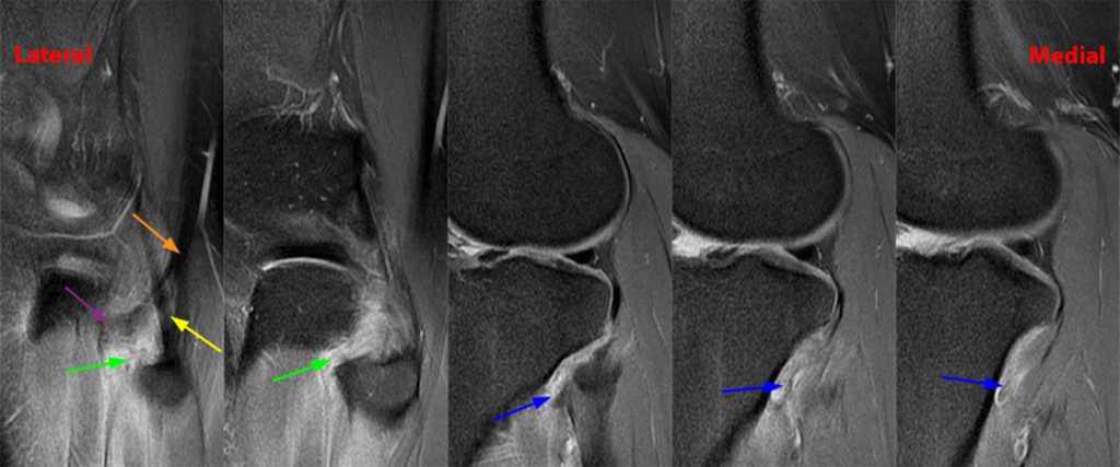 Medical image 2C: Axial images from superior to inferior demonstrate soft tissue edema surrounding the proximal tibiofibular joint.