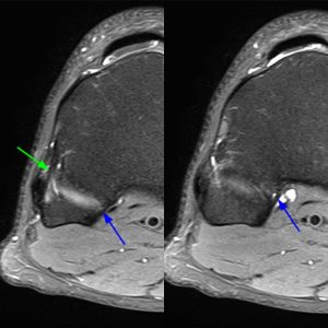 Medical image 5A: Axial fat-suppressed proton density-weighted images demonstrate the anterior and posterior PTFJ ligaments.