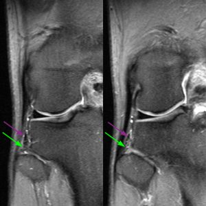 Medical image 5B: Coronal fat-suppressed proton density-weighted images demonstrate the anterior and posterior PTFJ ligaments.