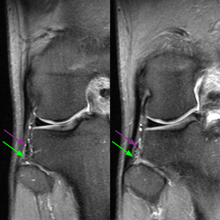 Medical image 5B: Coronal fat-suppressed proton density-weighted images demonstrate the anterior and posterior PTFJ ligaments.