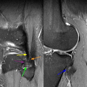 Medical image 5C: Sagittal fat-suppressed proton density-weighted images demonstrate the anterior and posterior PTFJ ligaments.