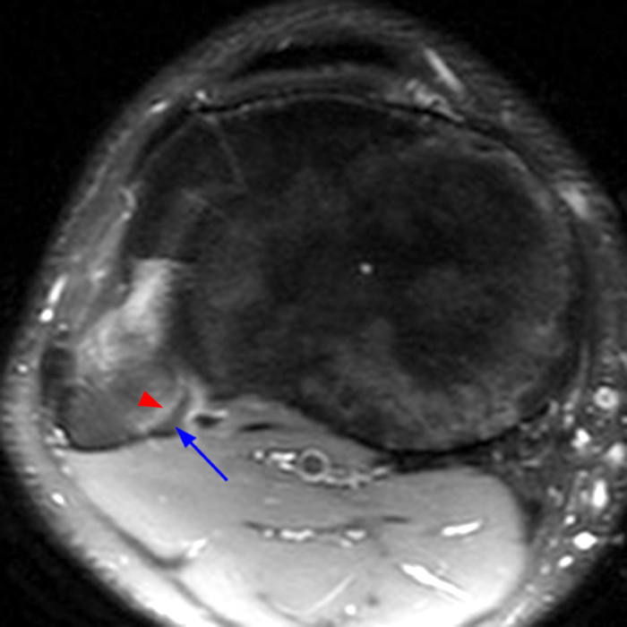 Medical image 6A: Axial fat-suppressed proton density-weighted image