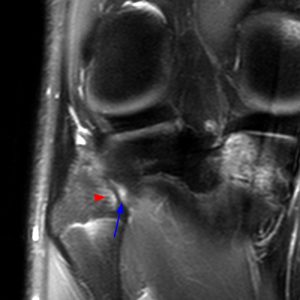 Medical image 6B: Coronal fat-suppressed proton density-weighted image