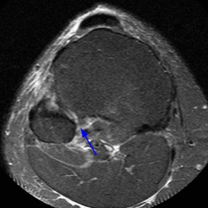 Medical image 7A: Axial fat-suppressed proton density-weighted image