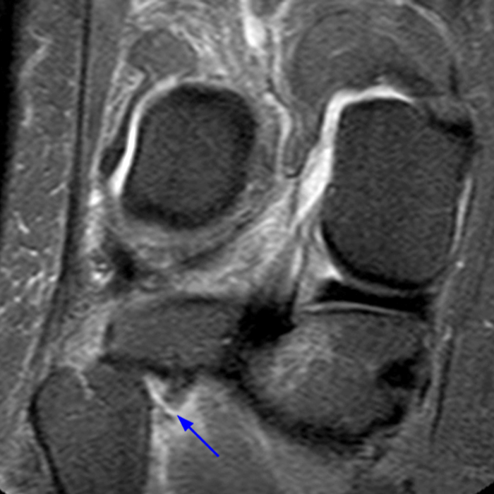 Medical image 7B: Coronal fat-suppressed proton density-weighted image