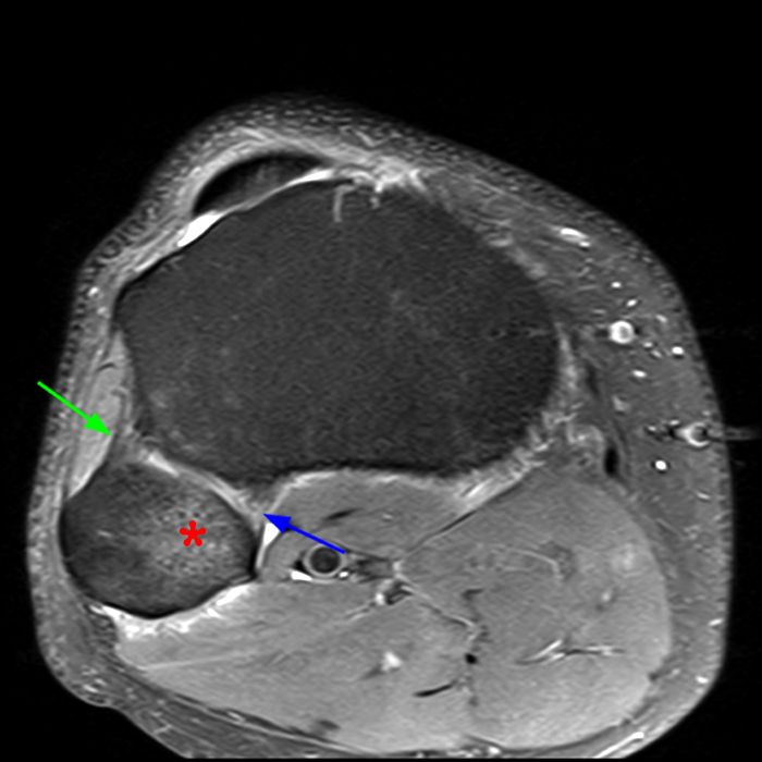 Medical image 8A: Axial fat-suppressed proton density-weighted image