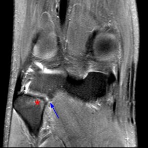 Medical image 8B: Coronal fat-suppressed proton density-weighted image
