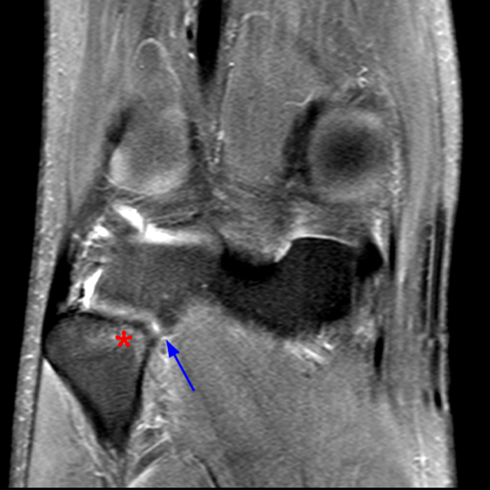 Medical image 8B: Coronal fat-suppressed proton density-weighted image