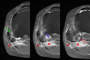 Medical image 9A: Sequential axial fat-suppressed proton density-weighted images