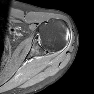Medical image: Proton density-weighted axial image of left shoulder