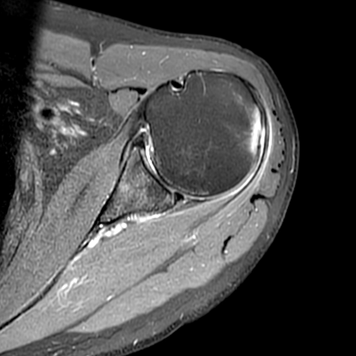 Medical image: Proton density-weighted axial image of left shoulder