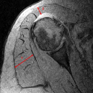 Medical image: Caudal extension lateral recess subacromial bursa