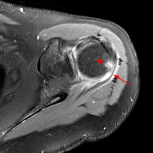 Medical image of shoulder: abnormalities likely related to a high and deep injection.