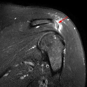Medical image: Injury/inflammation of the lateral deltoid muscle origin