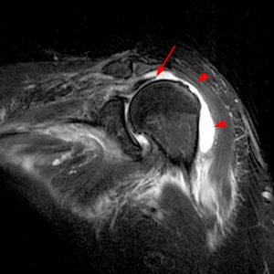 Medical image of shoulder: Communication of the subacromial bursa and glenohumeral joint through a large rotator cuff tear.