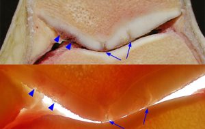 Medical image: Fissuring involving the patellar cartilage