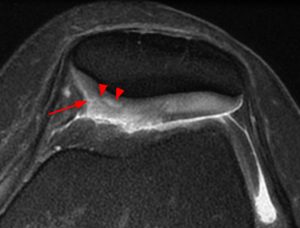 Medical image: Fissuring of the patellar cartilage