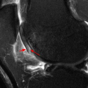 Medical image: Sagittal T2-weighted fat-suppressed MR image demonstrating fissuring of the trochlear cartilage
