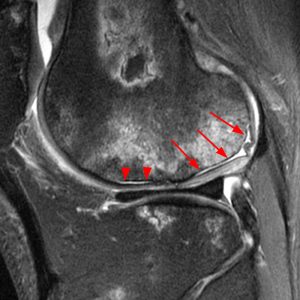 Medical image: 42 year-old man with a history of plasmacytoma of the left humerus and polyneuropathy