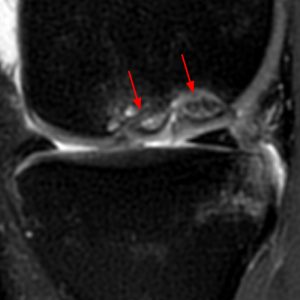Medical image: Osteochondritis dissecans of the medial femoral condyle with two unstable osteochondral fragments