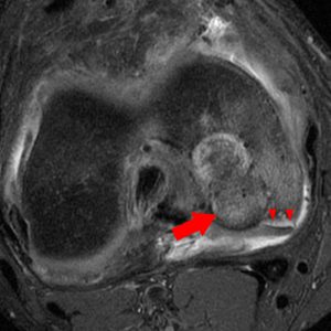 Medical image: Osteochondritis dissecans of the medial femoral condyle with two unstable osteochondral fragments