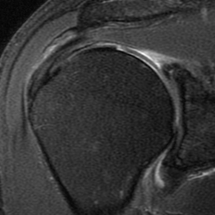 Modes of rotator cuff failure. Notes: ( A ) Intact repair on MRI
