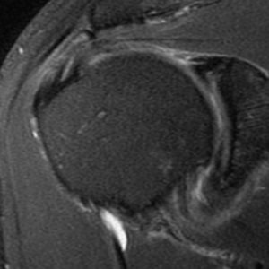 Medical images: T2-weighted fat-suppressed coronal MR image of the right shoulder