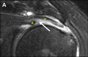 Medical image: Full-thickness delaminating supraspinatus tendon tear