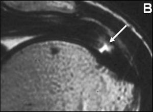Medical image: partial thickness intrasubstance tear