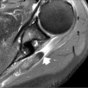 Medical image: a novel lesion of the infraspinatus tendon
