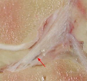 Sagittal sectional image in a cadaveric specimen with “cystic delamination” of the anterior cruciate ligament