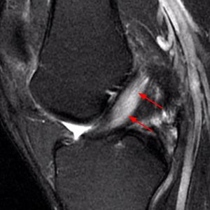 Medical image: 40 year-old man demonstrating diffuse thickening and increased signal of the anterior cruciate ligament