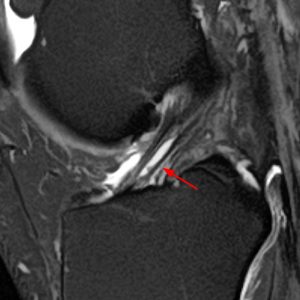 Medical image: 28 year-old professional rugby player with mucoid delamination (arrow) of the anterior cruciate ligament