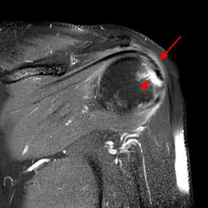 Medical image: Coronal T2-weighted fat-suppressed image of the shoulder demonstrates chondral delamination