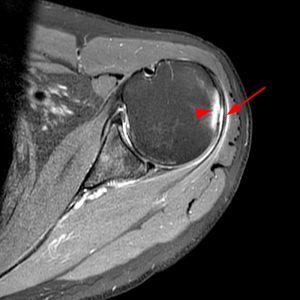 Medical image: Coronal T2-weighted fat-suppressed image of the shoulder demonstrates chondral delamination