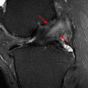Medical image: 65 year-old man with mucoid degeneration of both the anterior cruciate ligament and posterior cruciate ligament