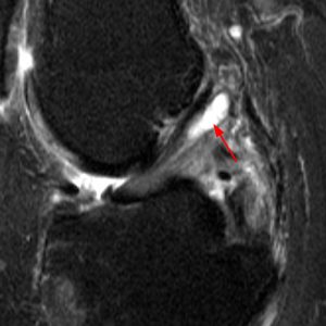 Sagittal T2-weighted fat-suppressed MR image