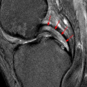 Medical image: 52 year-old man with severe knee pain demonstrating increased intrasubstance signal in the posterior cruciate ligament with a “tram-track” appearance