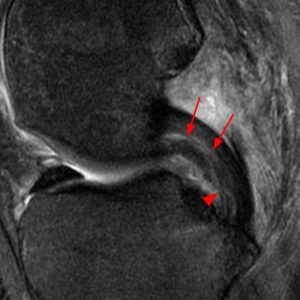Medical image: 40 year-old man with a delaminated partial tear of the posterior cruciate ligament and surrounding soft tissue edema